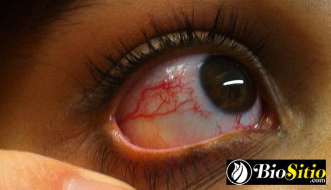 Ataxia-telangiectasia