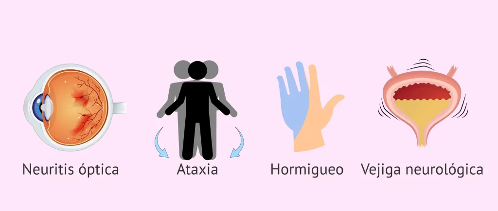 Esclerosis Múltiple