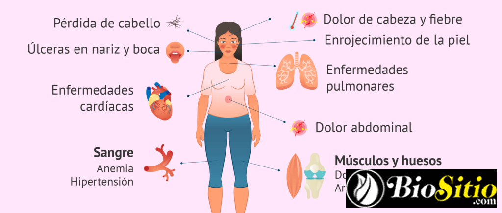 Lupus Eritematoso Sistémico