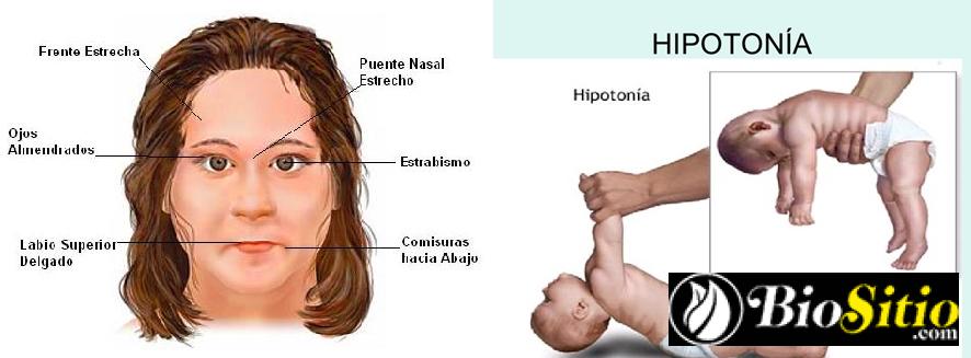 Síndrome De Prader-Willi