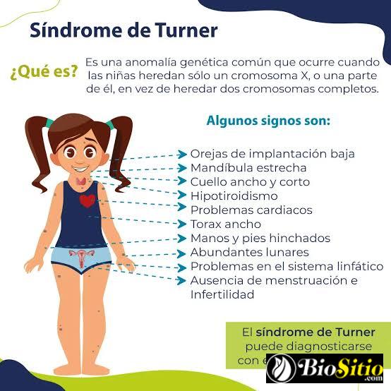 Síndrome De Turner