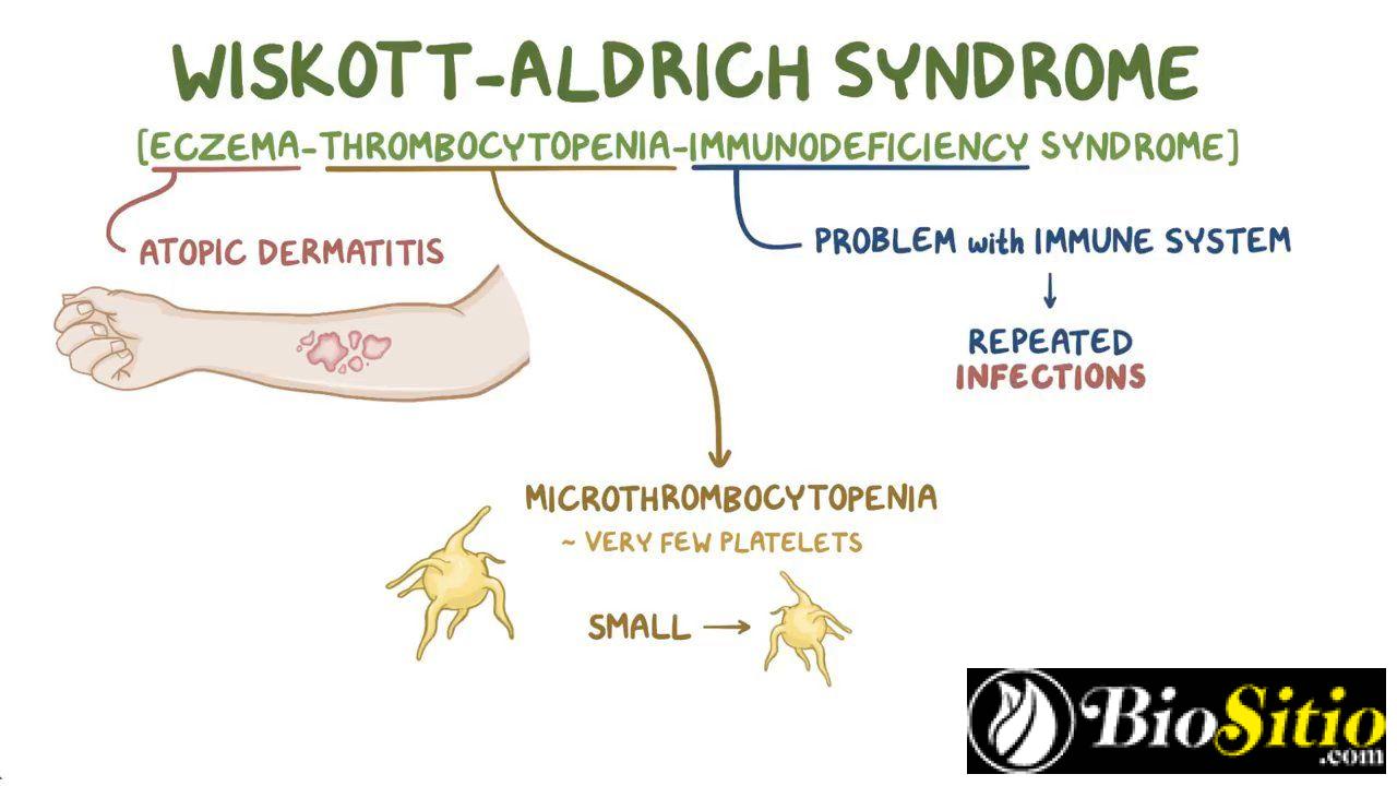 Síndrome De Wiscott-Aldrich